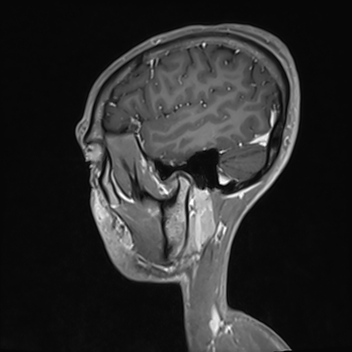 File:Basilar artery perforator aneurysm (Radiopaedia 82455-97733 G 121).jpg