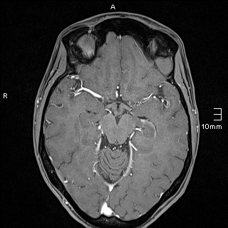 File:Basilar artery perforator aneurysm (Radiopaedia 82455-99523 G 60).jpg
