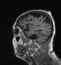Behavioral variant frontotemporal dementia and late onset schizophrenia (Radiopaedia 52197-58083 Sagittal T1 81).png