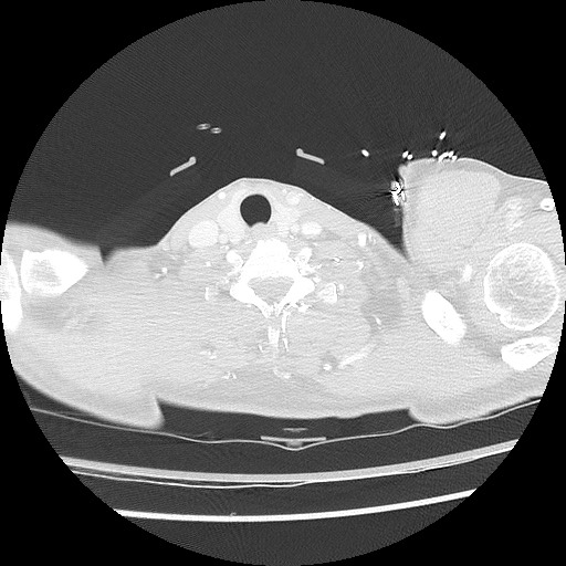 Benign post-traumatic pseudopneumoperitoneum (Radiopaedia 71199-81495 Axial lung window 7).jpg