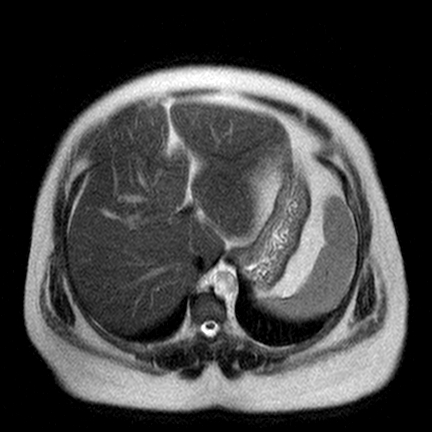 File:Benign seromucinous cystadenoma of the ovary (Radiopaedia 71065-81300 Axial T2 17).jpg