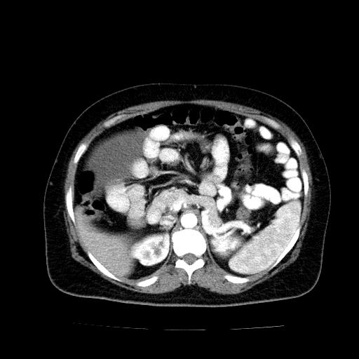 Benign spindle cell tumor - abdominopelvic (Radiopaedia 61300-69212 A 18).jpg