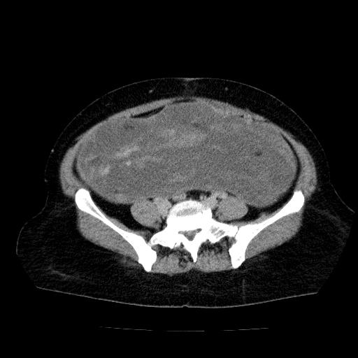 Benign spindle cell tumor - abdominopelvic (Radiopaedia 61300-69212 Axial C+ delayed 44).jpg
