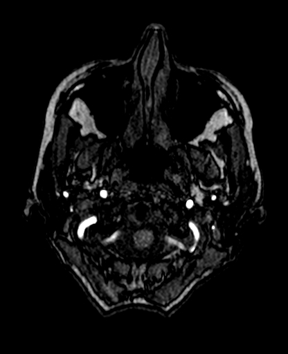 Berry aneurysm of the terminal internal carotid artery (Radiopaedia 88286-104918 Axial TOF 33).jpg
