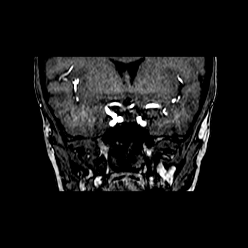 File:Berry aneurysm of the terminal internal carotid artery (Radiopaedia 88286-104918 Coronal TOF 35).jpg