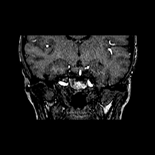Berry aneurysm of the terminal internal carotid artery (Radiopaedia 88286-104918 Coronal TOF 49).jpg