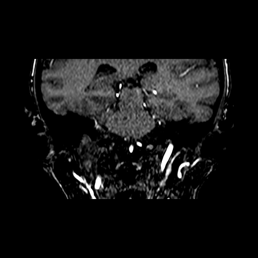File:Berry aneurysm of the terminal internal carotid artery (Radiopaedia 88286-104918 Coronal TOF 65).jpg