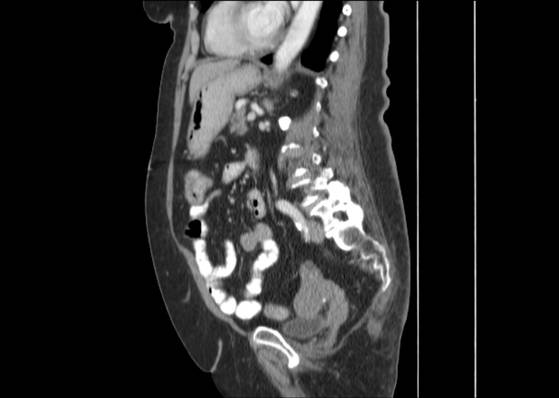 Bicameral celiacomesenteric aneurysm (Radiopaedia 55766-62327 B 35).jpg