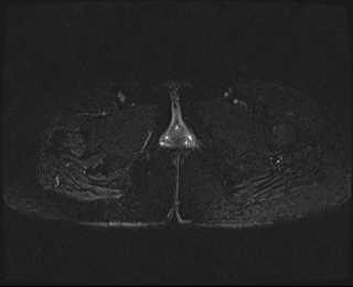 File:Bicornuate bicollis uterus (Radiopaedia 61626-69616 Axial PD fat sat 38).jpg