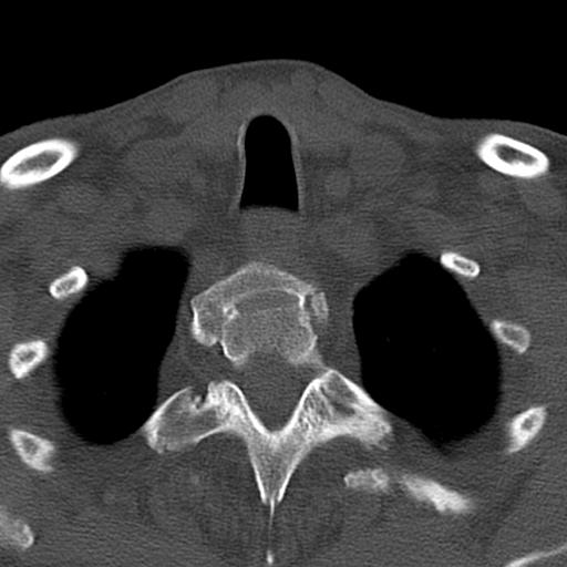 File:Bilateral C6-7 locked facet dislocation (Radiopaedia 28506-28748 Axial bone window 43).jpeg