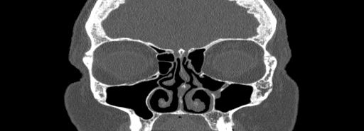 Bilateral Ectopic Infraorbital Nerves (Radiopaedia 49006-54084 Coronal bone window 23).jpg