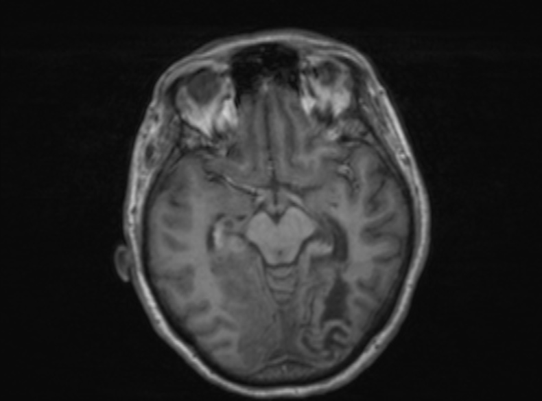 Bilateral PCA territory infarction - different ages (Radiopaedia 46200-51784 Axial T1 262).jpg