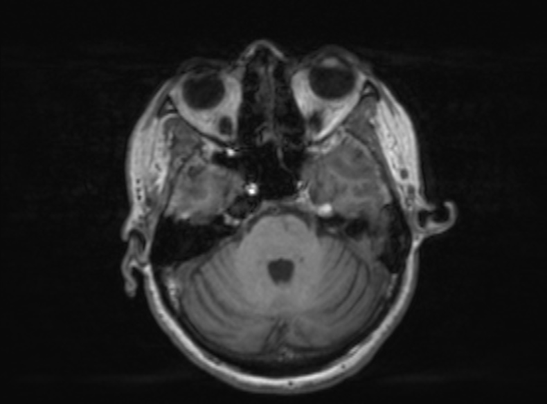 File:Bilateral PCA territory infarction - different ages (Radiopaedia 46200-51784 Axial T1 296).jpg