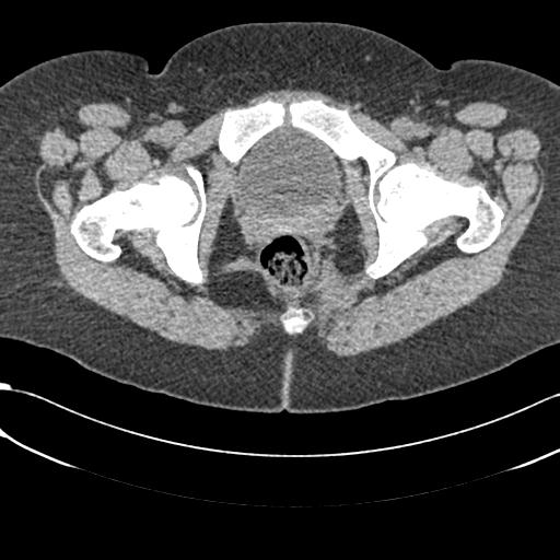 Bilateral acetabular protrusion with pincer type femoro-acetabular impingement (Radiopaedia 30134-30733 AXIAL SOFT THIN 59).jpg