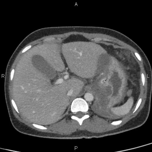 Bilateral adrenal gland hyperenhancement in pancreatitis (Radiopaedia 86642-102753 E 21).jpg