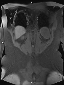 Bilateral adrenal myelolipoma (Radiopaedia 63058-71537 Coronal T1 fat sat 15).jpg