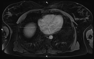 Bilateral adrenal myelolipoma (Radiopaedia 63058-71537 G 6).jpg