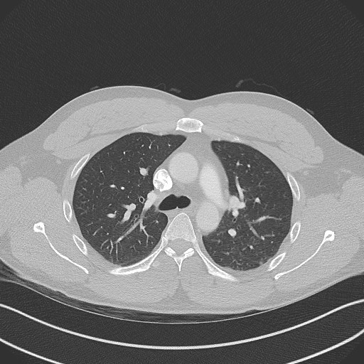 Bilateral atelectasis (Radiopaedia 48666-53675 Axial lung window 40).jpg