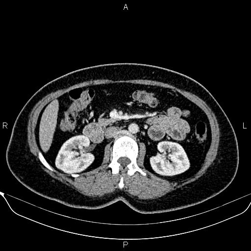 Bilateral benign adrenal adenomas (Radiopaedia 86912-103124 B 49).jpg