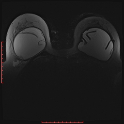 File:Bilateral breast implant rupture (Radiopaedia 24761-25027 PASTA Si 16).jpg