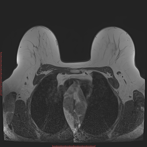 File:Bilateral breast implant rupture (Radiopaedia 24761-25027 T1 12).jpg
