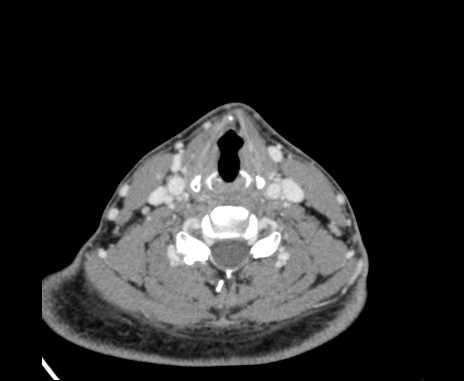 Bilateral carotid body tumors (Radiopaedia 61841-69870 Axial Post contrast 73).jpg