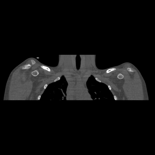 File:Bilateral chronic posterior shoulder dislocation (Radiopaedia 39213-41452 Coronal bone window 17).jpg