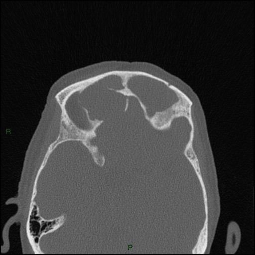 Bilateral frontal mucoceles (Radiopaedia 82352-96454 Axial bone window 111).jpg