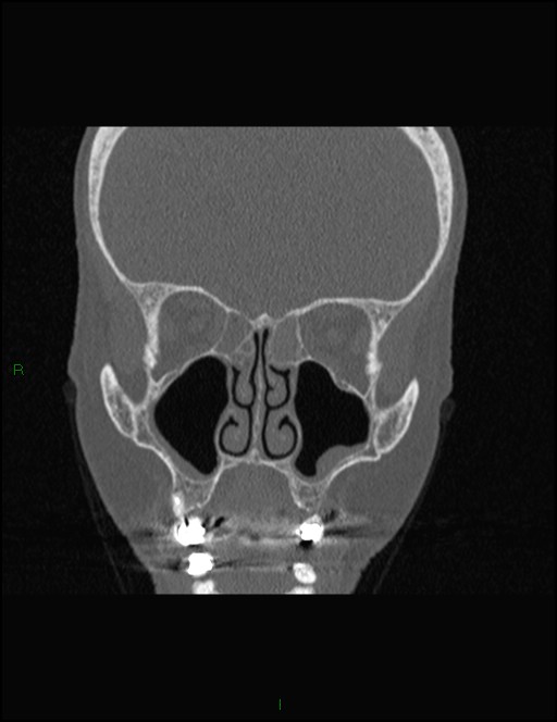 Bilateral frontal mucoceles (Radiopaedia 82352-96454 Coronal 148).jpg
