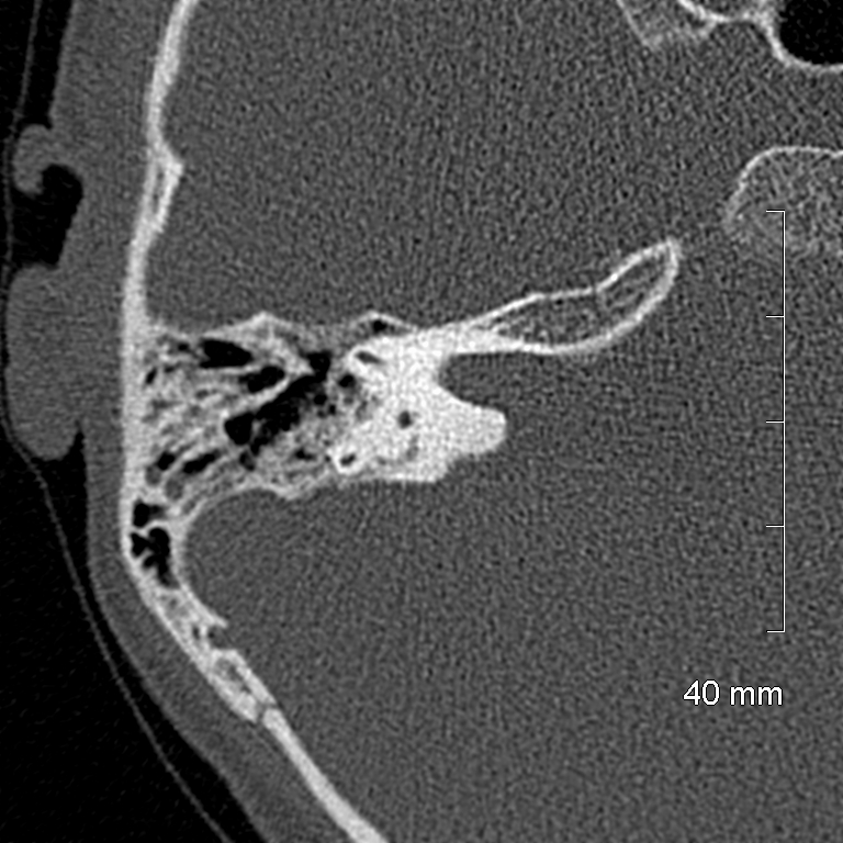 Bilateral grommets (Radiopaedia 47710-52404 Axial bone window 48).jpg
