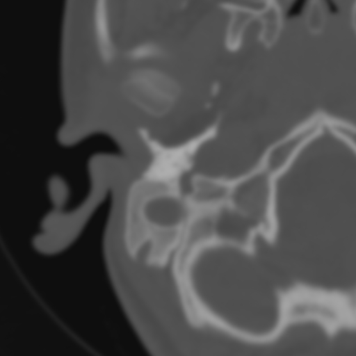 Bilateral otosclerosis (Radiopaedia 57237-64157 B 19).jpg