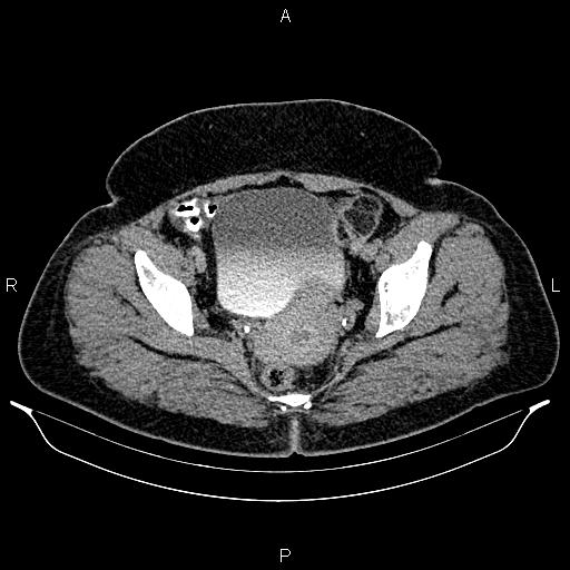 File:Bilateral ovarian dermoid cysts (Radiopaedia 85785-101603 Axial C+ delayed 75).jpg