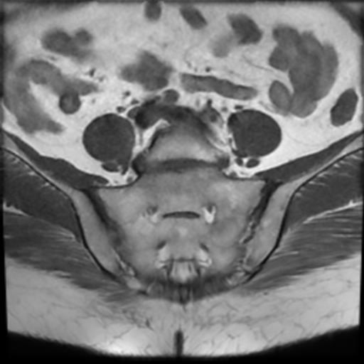 File:Bilateral ovarian dermoid cysts (Radiopaedia 90152-107338 Axial T1 2).jpg