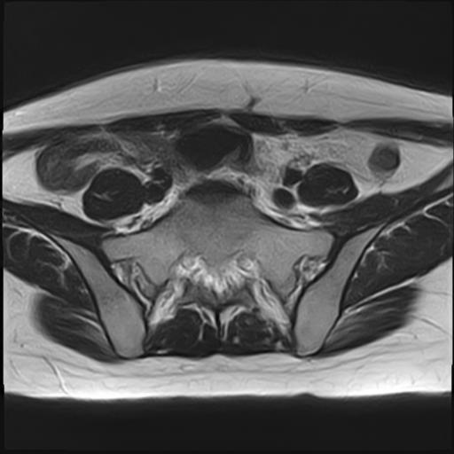 File:Bilateral ovarian endometriomas (Radiopaedia 87085-103347 Axial T2 2).jpg