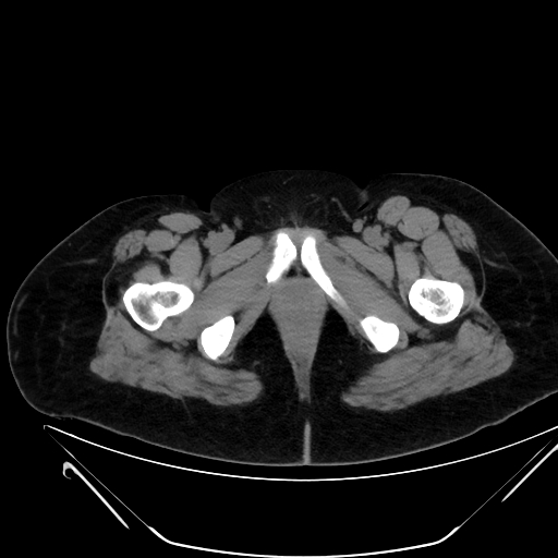 File:Bilateral ovarian mature cystic teratomas (Radiopaedia 79373-92457 Axial non-contrast 98).jpg