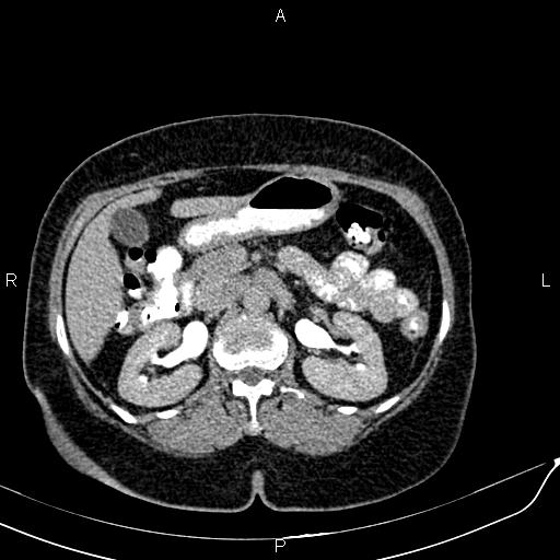 Bilateral ovarian serous cystadenocarcinoma (Radiopaedia 86062-101989 Axial C+ delayed 20).jpg