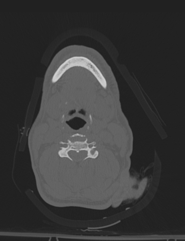 Bilateral perched facet joint (Radiopaedia 63149-71669 Axial bone window 27).jpg