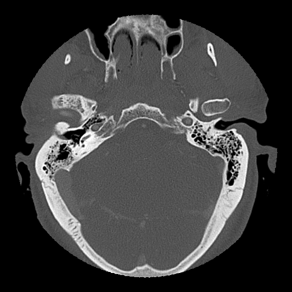File:Bilateral perched facets with cord injury (Radiopaedia 45587-49713 Axial bone window 8).jpg