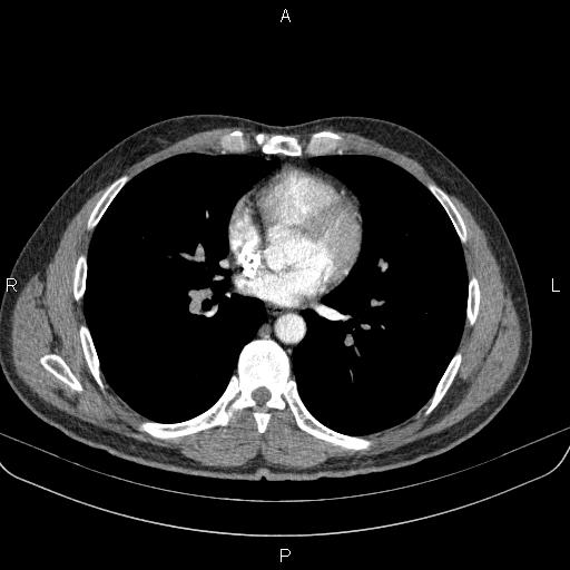 Bilateral pulmonary AVM (Radiopaedia 83134-97505 A 42).jpg