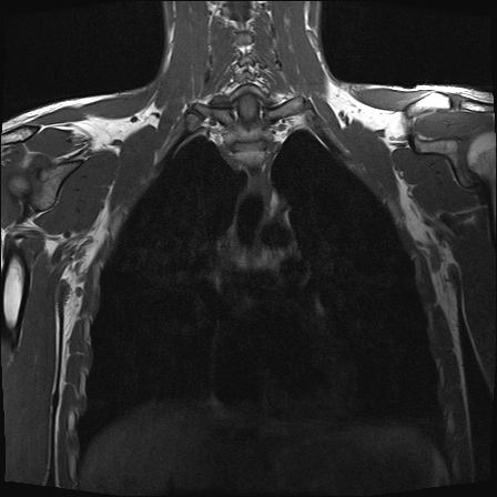 File:Bilateral spinoglenoid notch ganglion cysts (Radiopaedia 29577-30082 Coronal T1 16).jpg