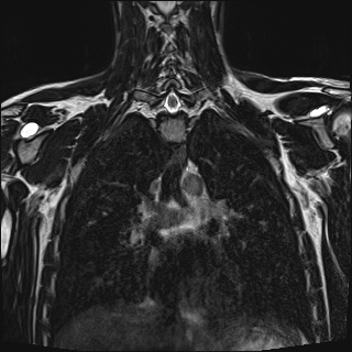 Bilateral spinoglenoid notch ganglion cysts (Radiopaedia 29577-30082 Coronal T2 71).jpg
