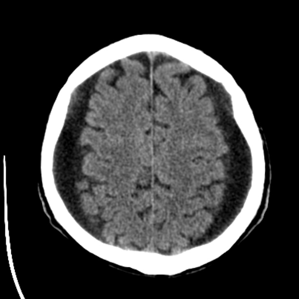 Bilateral subdural hygromata (Radiopaedia 29245-29656 Axial non-contrast 36).jpg