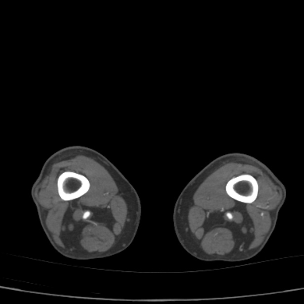 Bilateral superficial femoral arterial occlusion (Radiopaedia 25682-25857 A 52).jpg