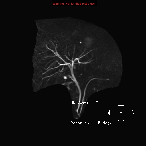 File:Biliary tree anatomical variant - biliary trifurcation (Radiopaedia 12531-12750 Coronal 3D MRCP 1).jpg