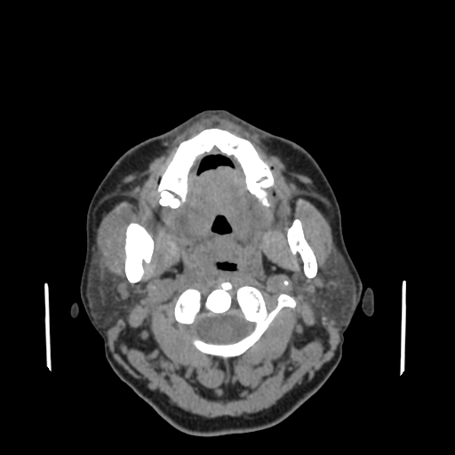 Bisphosphonate-related osteonecrosis of the jaw (Radiopaedia 71324-81642 non-contrast 100).jpg