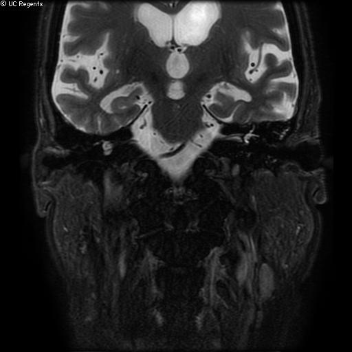 File:Bisphosphonate-related osteonecrosis of the maxilla (Radiopaedia 51367-57101 Coronal T2 fat sat 2).jpg