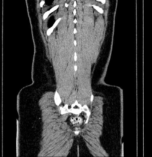 Blind-ending branch of a bifid ureter (Radiopaedia 61159-69048 C 65).jpg