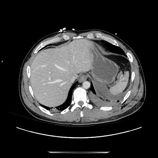 Blunt abdominal trauma with solid organ and musculoskelatal injury with active extravasation (Radiopaedia 68364-77895 A 20).jpg