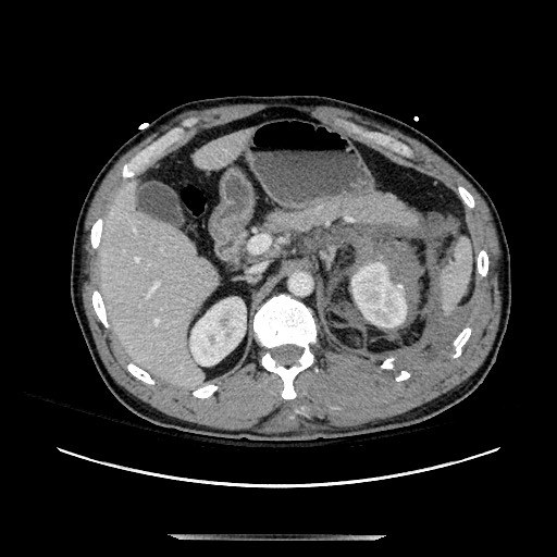Blunt abdominal trauma with solid organ and musculoskelatal injury with active extravasation (Radiopaedia 68364-77895 A 40).jpg
