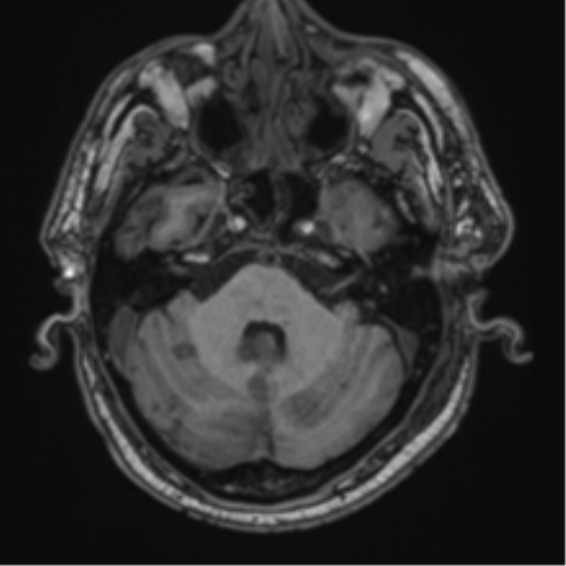 File:Blunt cerebrovascular injury (Radiopaedia 53682-59745 Axial T1 9).png